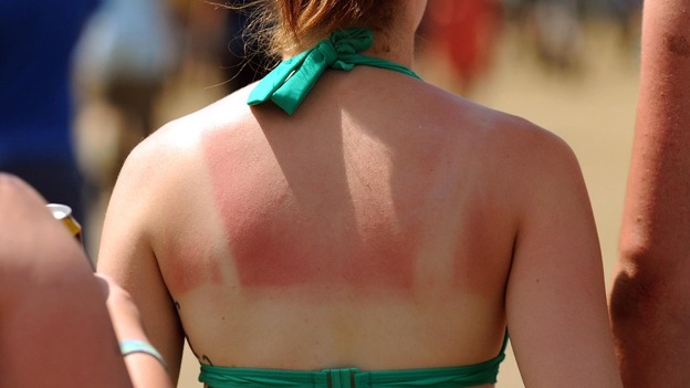 Skin Cancer Rates Are Soaring In The UK