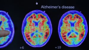 Simple at home test can predict Alzheimers risk says study