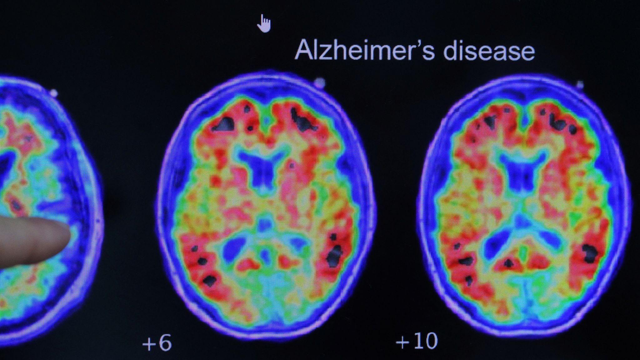 Simple at home test can predict Alzheimers risk says study