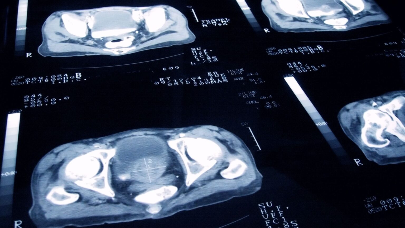 Vital clues could help predict prostate cancer years in advance